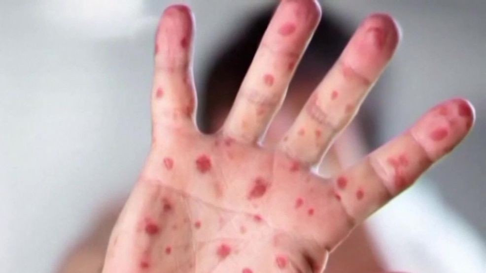 Image for story: Measles outbreak in Oklahoma rises to 12 cases