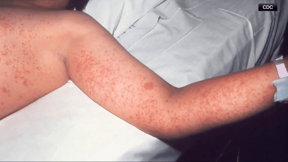 Image for story: Curry County infant diagnosed with measles, 1st case in Curry County